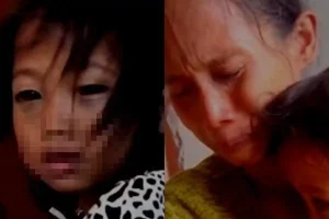 Ibu Laporkan Guru ke Polisi, Ternyata Mata Siswi SD Lebam Bukan Karena Penganiayaan: Sakit Batuk